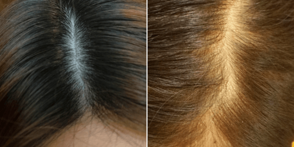 正常な髪の毛とびまん性脱毛症の比較